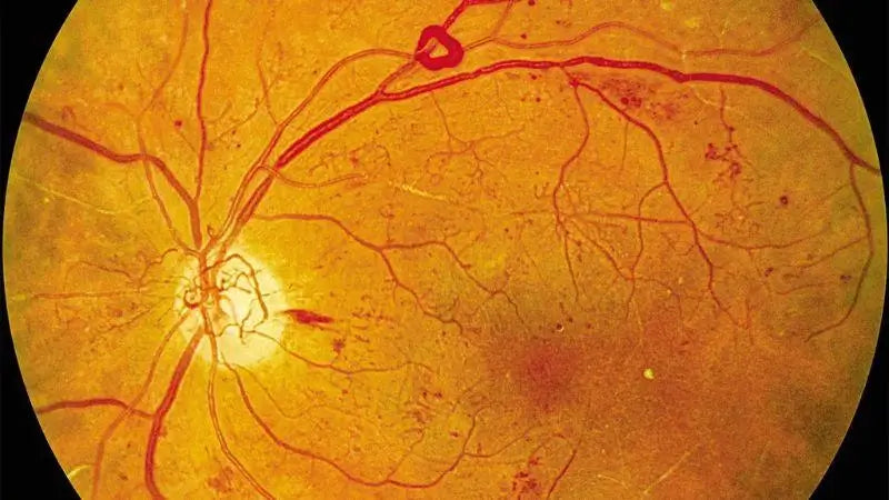 2. Silent Retinal Damage