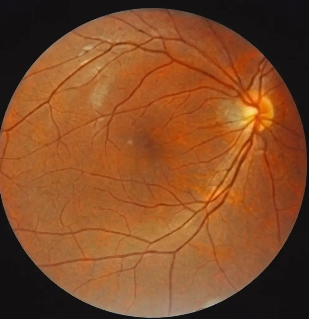 Fundus Image