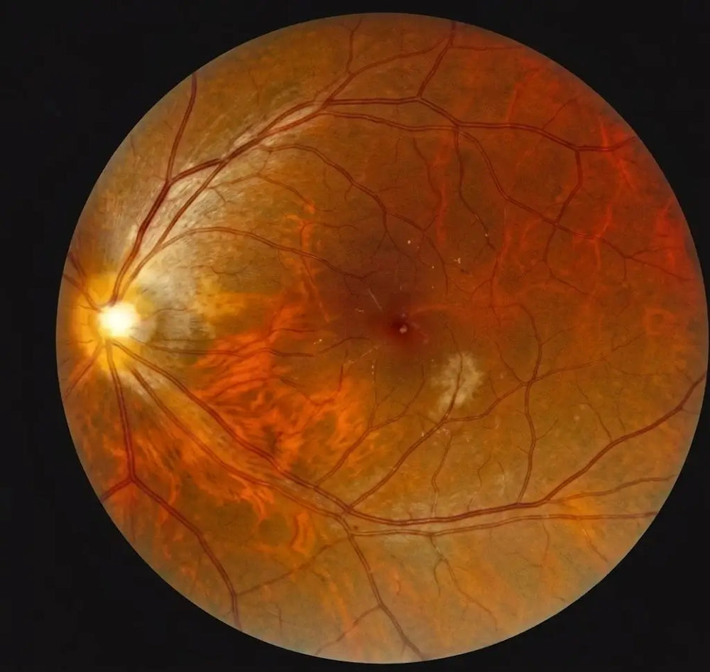 Fundus Image