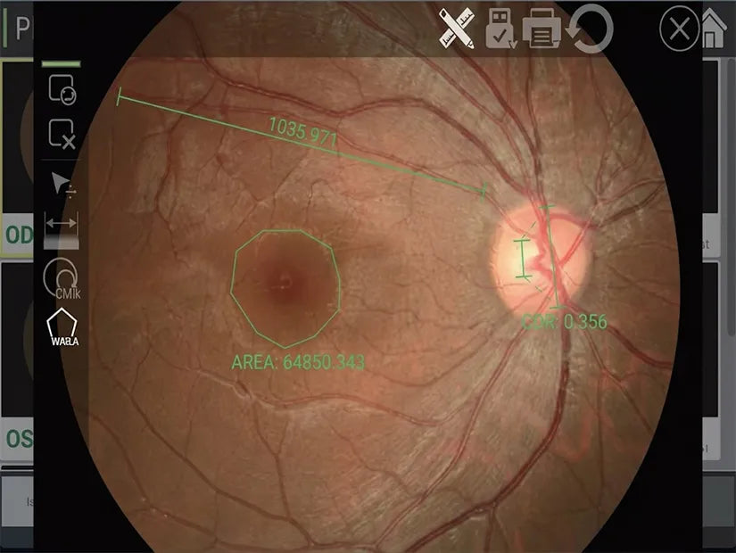 8MP Ultra-Clear Retinal Visualization